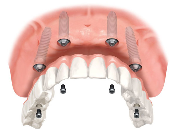 I Viaggi Del Sorriso - offerta impianti dentali