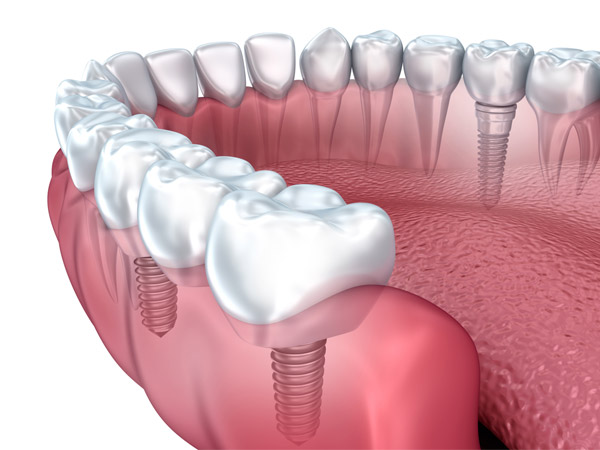 I Viaggi Del Sorriso - offerta impianti dentali